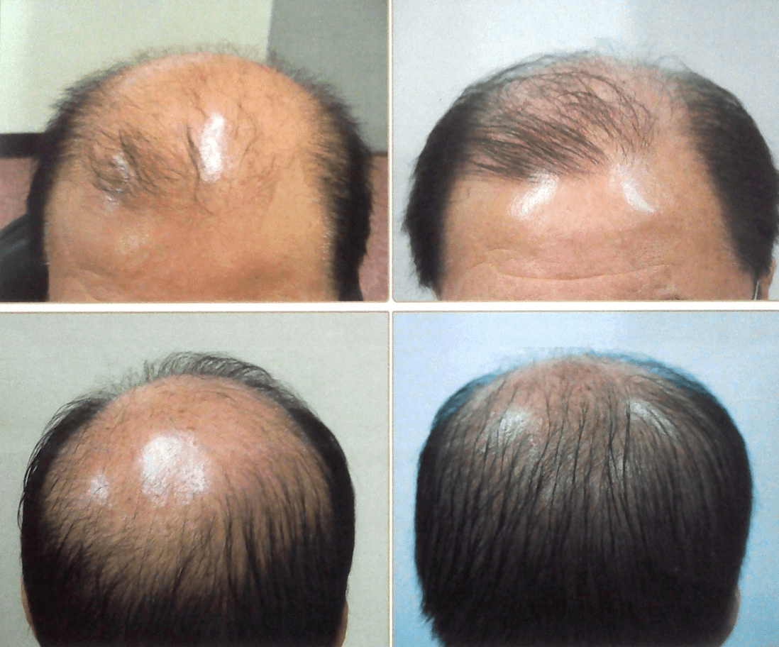 Hair Loss And Chemotherapy - Epic Merchant Services