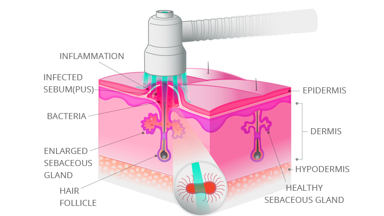 How does red light therapy work