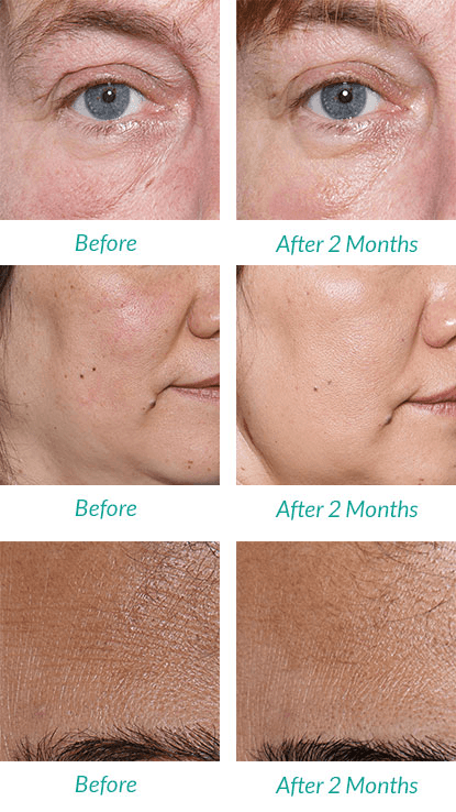 Microdermabrasion At Home Before And After