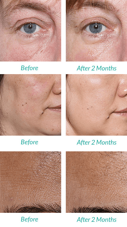 Microdermabrasion before and after 1