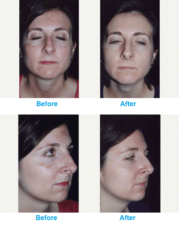 Microdermabrasion before and after 2