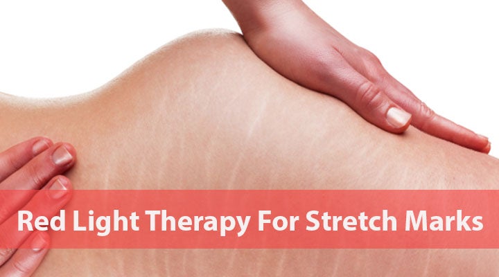 Red Light Therapy For Stretch Marks