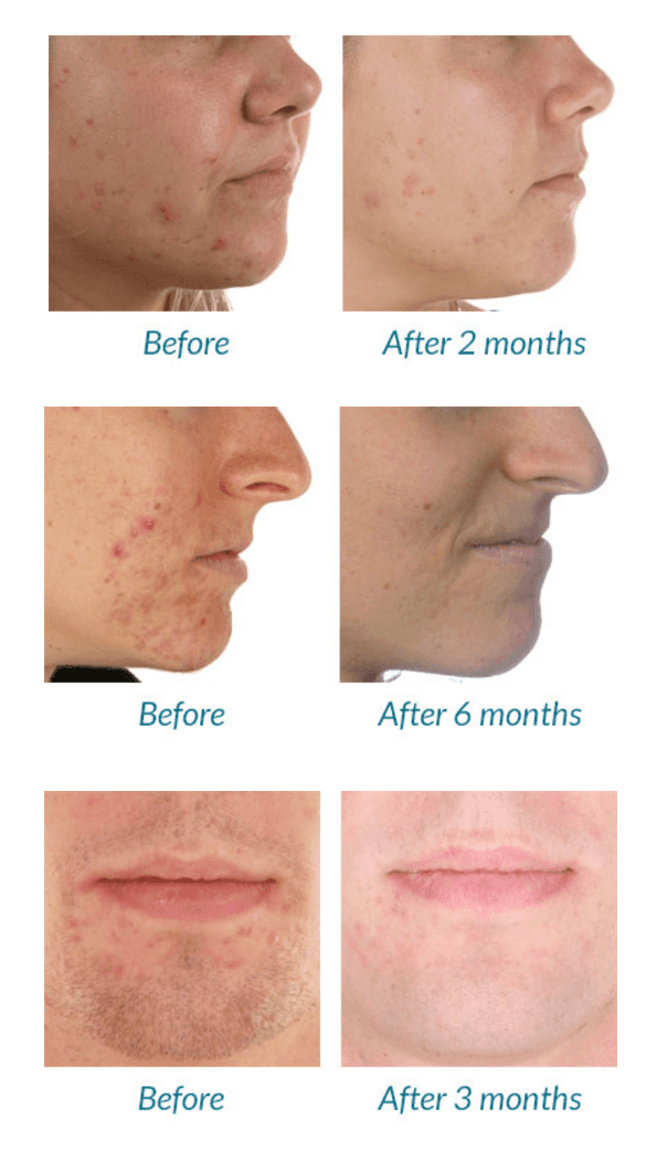 blue light therapy acne before and after