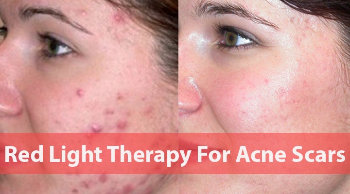 Red Light Therapy For Acne Scars
