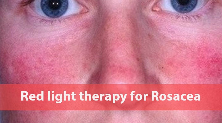 Red Light Therapy for Rosacea