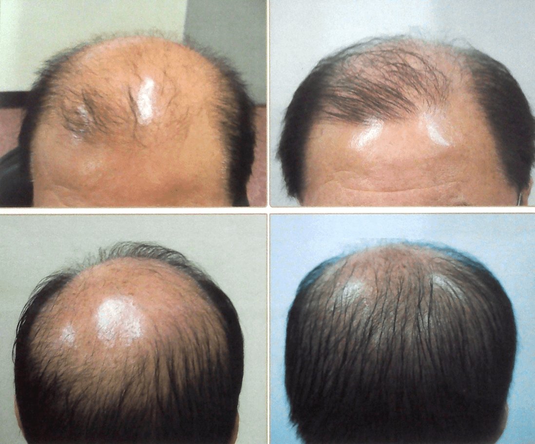 laser hair growth device treatment system loss irestore lllt does baldness therapy before low level helmet restore both buyer guide