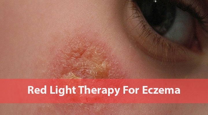 Red Light Therapy For Eczema