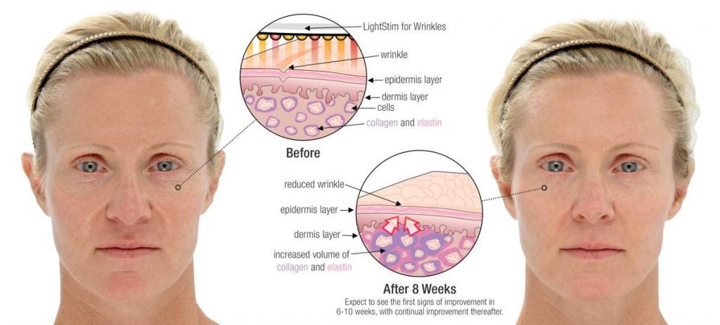 Lightstim before and after