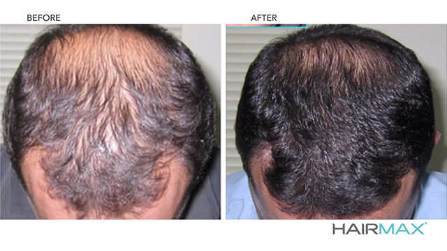 hairmax laserband 82 before and after 1