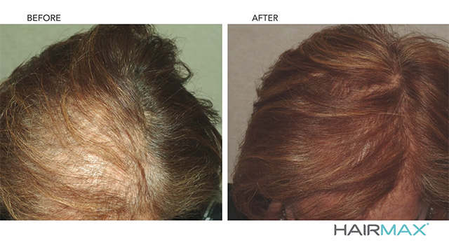 hairmax laserband 82 before and after 2